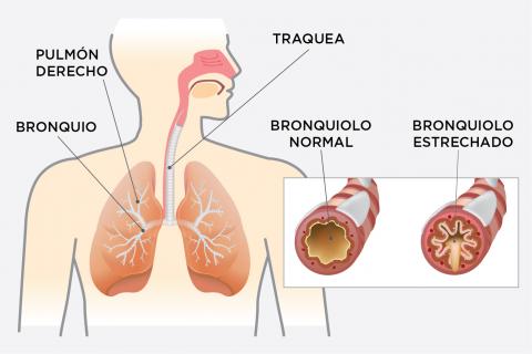 Enfisema y perdida de peso Enfisema y perdida de peso